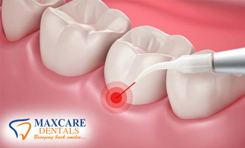 gumTreatment