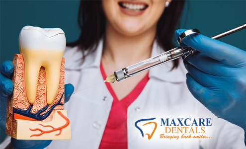 rootCanal