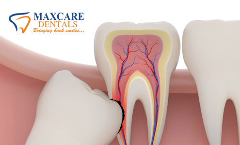 wisdom-tooth